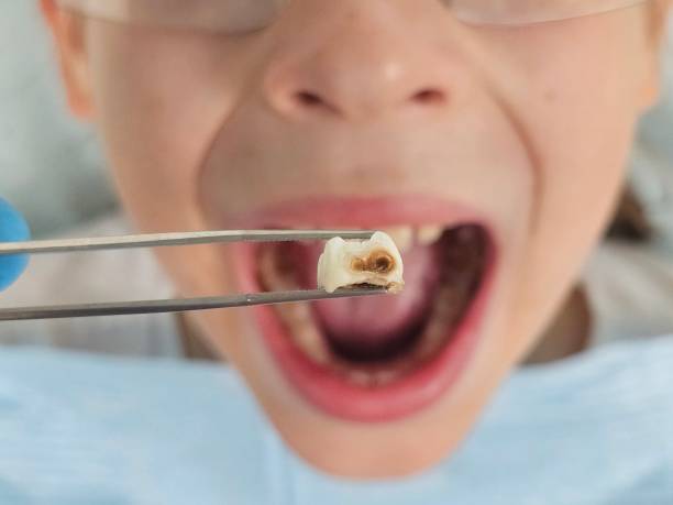 Best Emergency Tooth Extraction in Lake Dunlap, TX